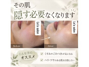 レア(Le'a)の写真/毛穴の黒ずみ・詰まり・開きをケアして、つるんとした陶器のような素肌へ導きます！自信の持てる肌へ整え♪