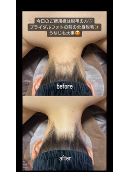 スピカ(Spica)/spicaの脱毛は効果抜群と好評♪