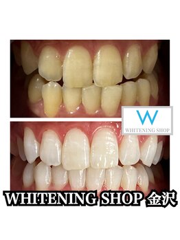 ホワイトニング ショップ 金沢店/肌が綺麗に！？ホワイトニング