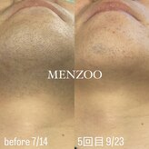 メンズー(MENZOO)