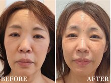 ドクターボディ 新宿店(Dr.Body)の雰囲気（【施術10回60代】歪み、顔の長さ、鼻の下を短くリフトアップ小顔）
