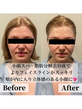 ラノン(LANON)/ビフォーアフター5