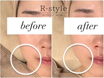 エステサロン アールスタイル(R-style)/テラボーラービフォーアフター