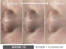 ひびき 京都烏丸御池店/毛穴洗浄でクリアなお肌へ★