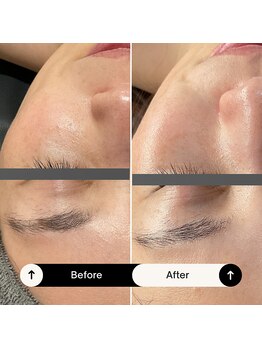 ホイップスパ(WHIP SPA)/毛穴洗浄＋深層導入スピ