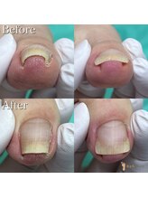 巻き爪補正店 越谷店/巻き爪ケア