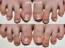 ニコプラス(NICO+)/フット爪育ネイルケア