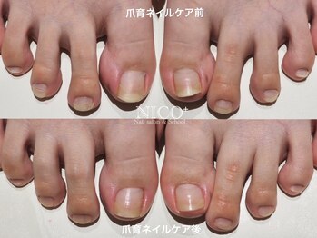 ニコプラス(NICO+)/フット爪育ネイルケア