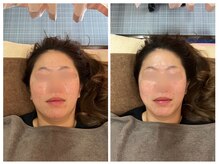 仁接骨院 じん鍼灸治療院/美容鍼灸