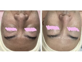 じゅえる/続き→ 光フェイシャルの効果