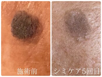 フォーチューン/シミの改善ケア