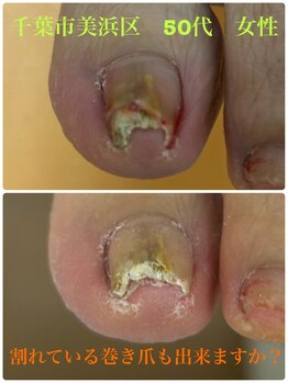 巻き爪じゅん 船橋店/割れた巻き爪もできますか？