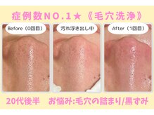 ウル 下北沢(Ulu)/韓国式３D毛穴洗浄