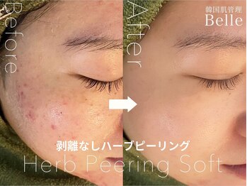 ベル 新潟(Belle)/ハーブピーリング|ニキビケア