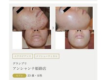 まりも化粧品店/ホワイトスノーピール