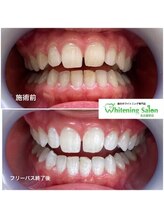 ホワイトニングサロン 名古屋駅店/【ホワイトニング施術例】