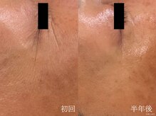 ウォーム(warm)/【肌質改善専門店warm】シワケア