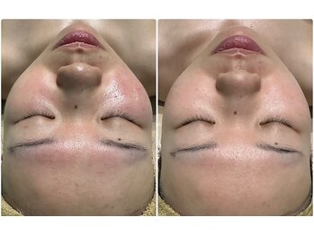 レクラ バイ ドクターエイチ(L'ECLAT by Doctor.H)/ハーブピーリング