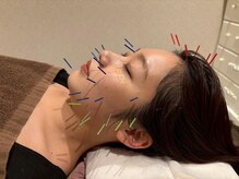 効果の即効性&効果が長続きする美容鍼【美容鍼】