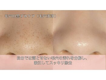 オーシャンブルー 時津店(OCEAN BLUE)/毛穴の黒ずみケア(毛穴洗浄)