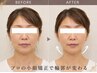 【頭痛の原因・食いしばり解消】小顔整体＋ドライヘッドスパ 合計50分