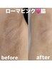 【話題のローマピンク】脇or肘★黒ずみ除去　￥220000→モニター価格￥132000