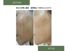 凛/若よもぎ蒸し　Before/After