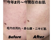 イリゼ(IRISE)/毛穴開きと赤ら顔が広がる～悩み