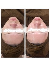 チル アウト(CHILL OUT)/ぴかぴか艶々お肌へ！