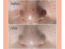 浜松富塚ベルミーランド/フェイシャルBefore→After