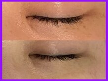 ヴィオール 名古屋栄店(VIOR)/シミ改善　光ショット施術！