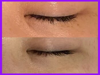 ヴィオール 名古屋栄店(VIOR)/シミ改善 光ショット施術!