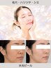 【ざらつき/肌質改善】触れたくなる、なめらか素肌へ｜水光ピール