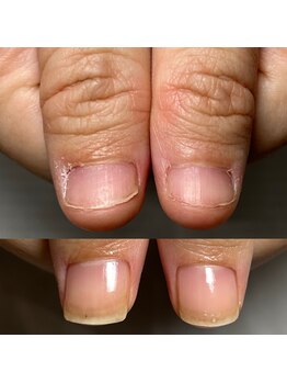 自爪育成ケアコース