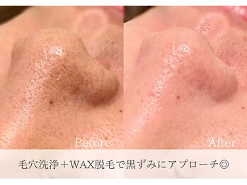 モカラ(MOKARA)/毛穴洗浄＋ワックス脱毛＋LDM