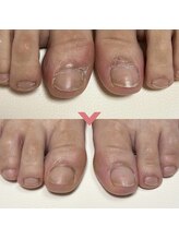 ワイ(Y)/フットケア