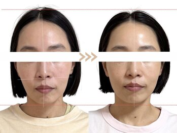 メラリノ(Melalino)/シンメトリー小顔整美5回♪