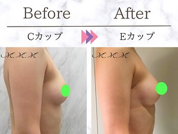 メディカルサロン エム エム エム 大阪梅田グランドサロン(M.M.M)/【バストアップ例】　C→Eカップ