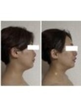 インフィニティ セルラム(INFINITY CELLULAM)/ビフォーアフター