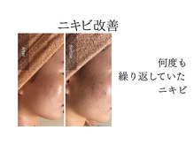 シャルナ(charna)/ニキビ改善