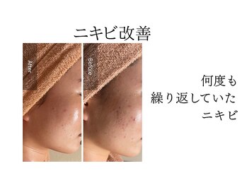 シャルナ(charna)/ニキビ改善