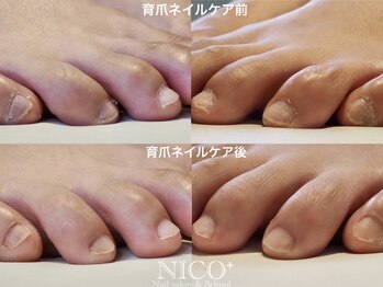 ニコプラス(NICO+)/フット爪育ネイルケア