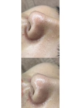 ホワイトアクア 梅田本店(WHITE AQUA)/ララピール/大阪/梅田/毛穴/小顔