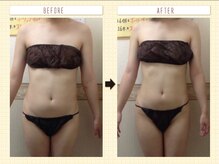 エステティックサロン ピュール ボーテ 東金店/ハイパーナイフ