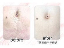 イチキュービー 仙台駅前東口店(19B)/お腹の脱毛