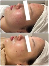 ビズビズ 天王寺店(bisebise)/ニキビ/毛穴開き黒ずみ角栓詰り