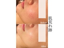 ビジュープラス 水戸店(Bijou+)/ニキビ・肌荒れ跡ケア