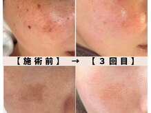 サロン マリー(SALON MARIE)の雰囲気（【濃いシミ・薄いシミ・か○ぱん】あらゆるシミに効果大◎）