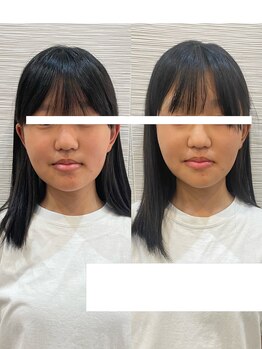 長寿鍼灸院 長寿整骨院/美容鍼25本の効果★リフトアップ