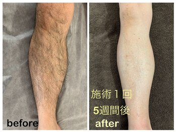 ビー(b.)/脱毛効果☆